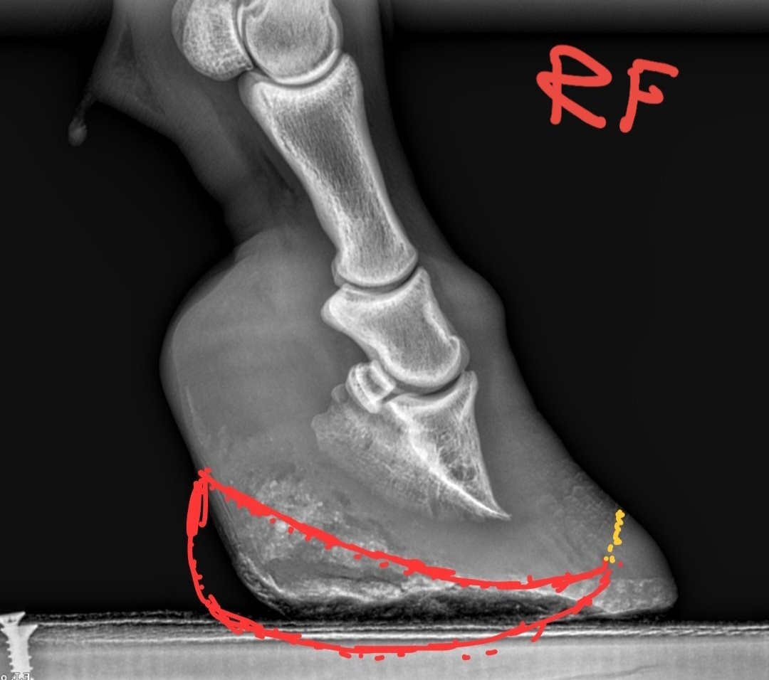 The planned shoe outline drawn by hand on the radiograph